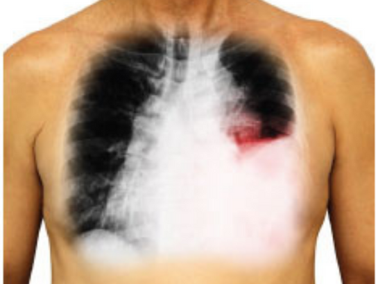 pleural-effusion-near-kondapur