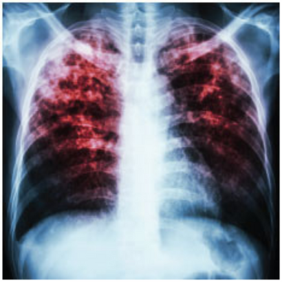 tuberculosis